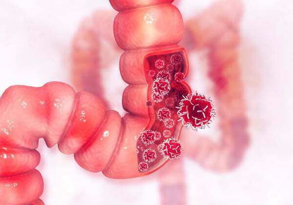 Stage-4-Colon-Cancer-Cells