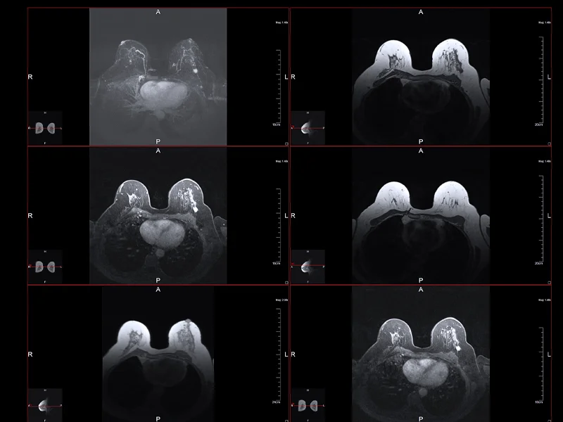 Hirschfeld-Oncology-Breast-Cancer-Chemotherapy