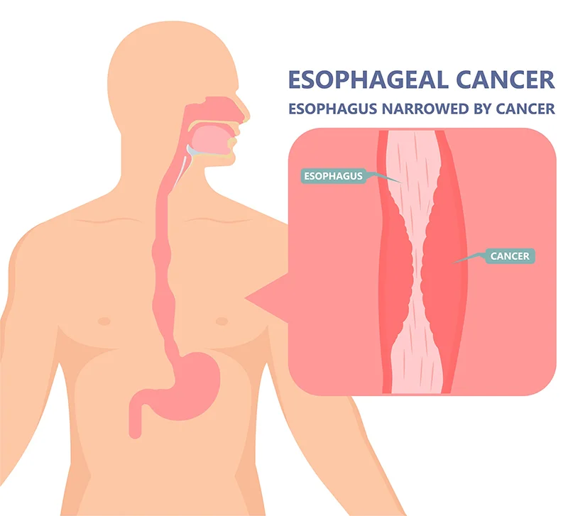 Narrowing-of-Esophagus-due-to-Cancer