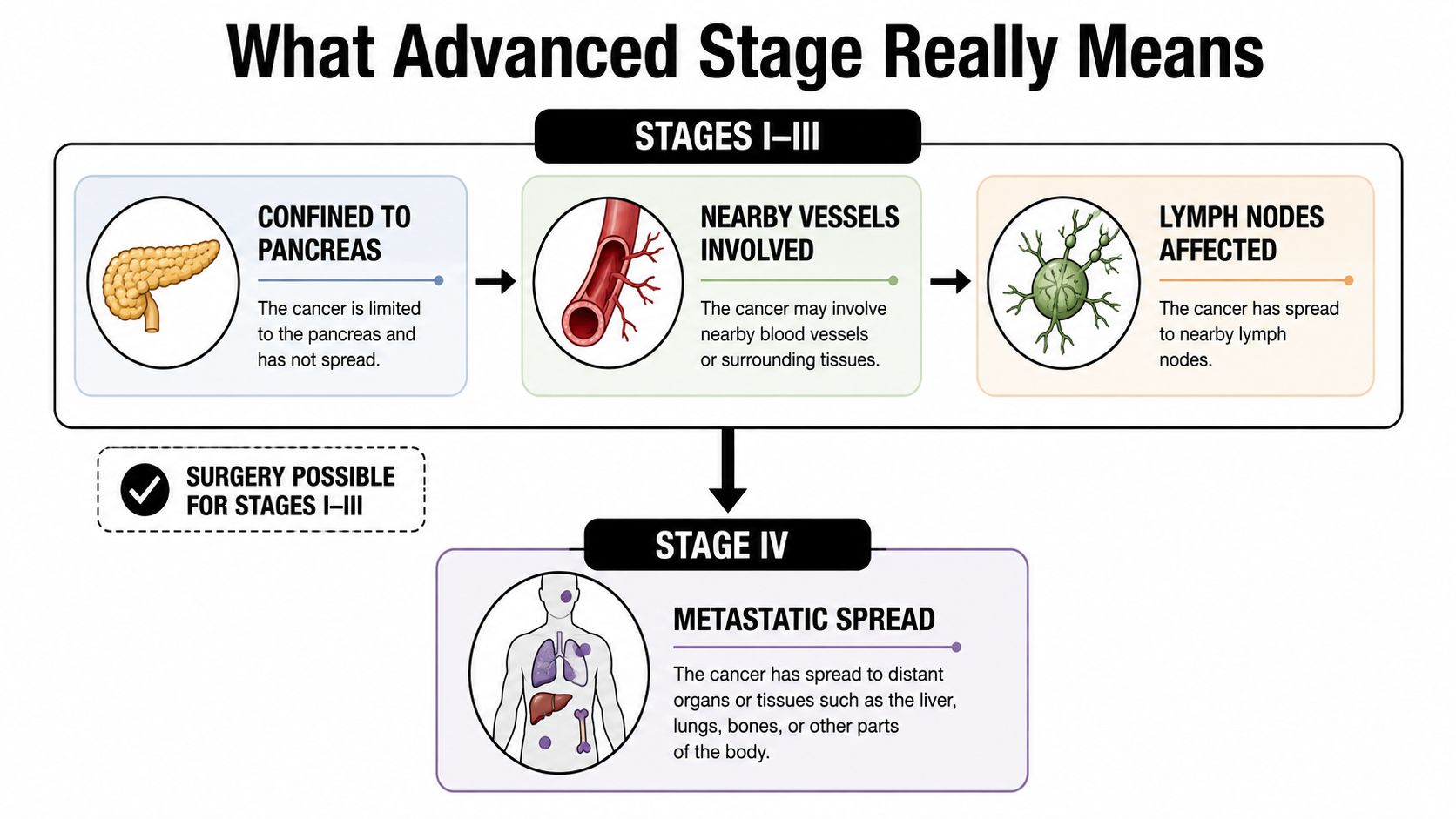 An infographic illustrating stages I-III and stage IV of pancreatic cancer, showing localized versus metastatic progression.