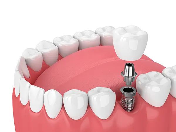 model of a dental implant