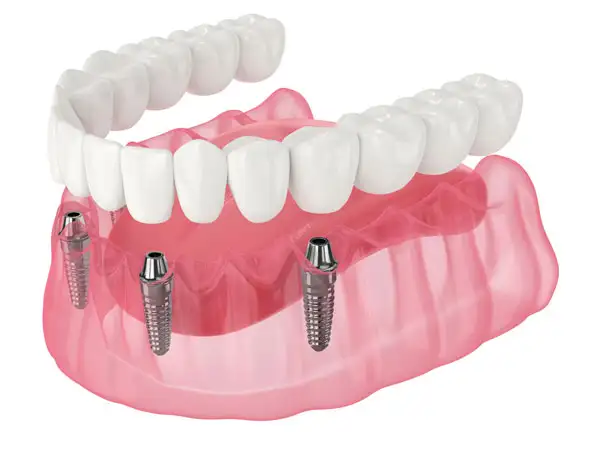 model of dental implants