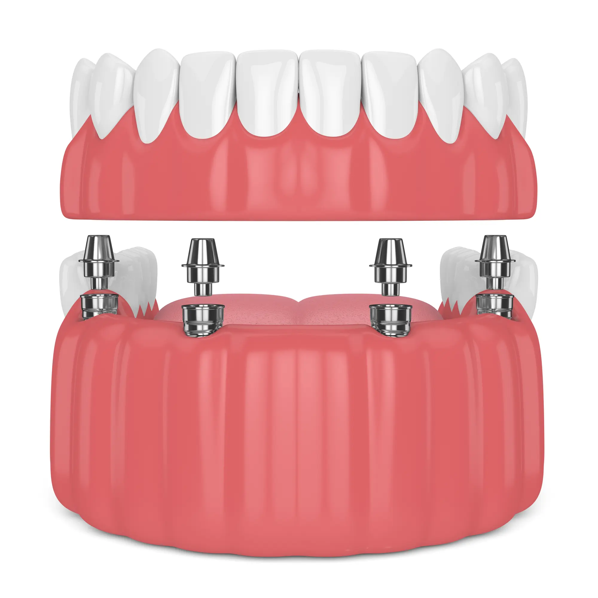 model of full arch implants