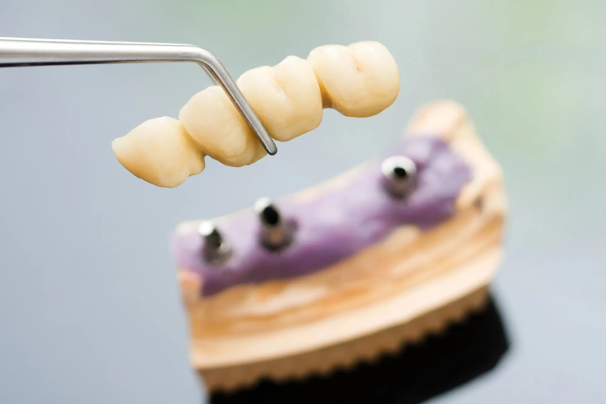 Dental bridges
