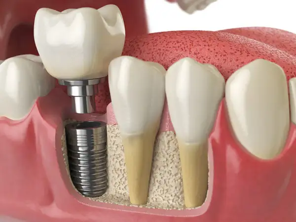dental implant model