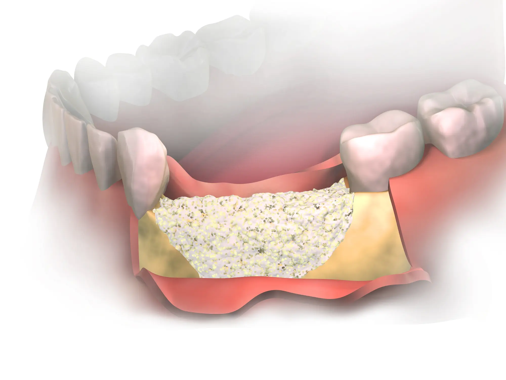 bone graft illustration