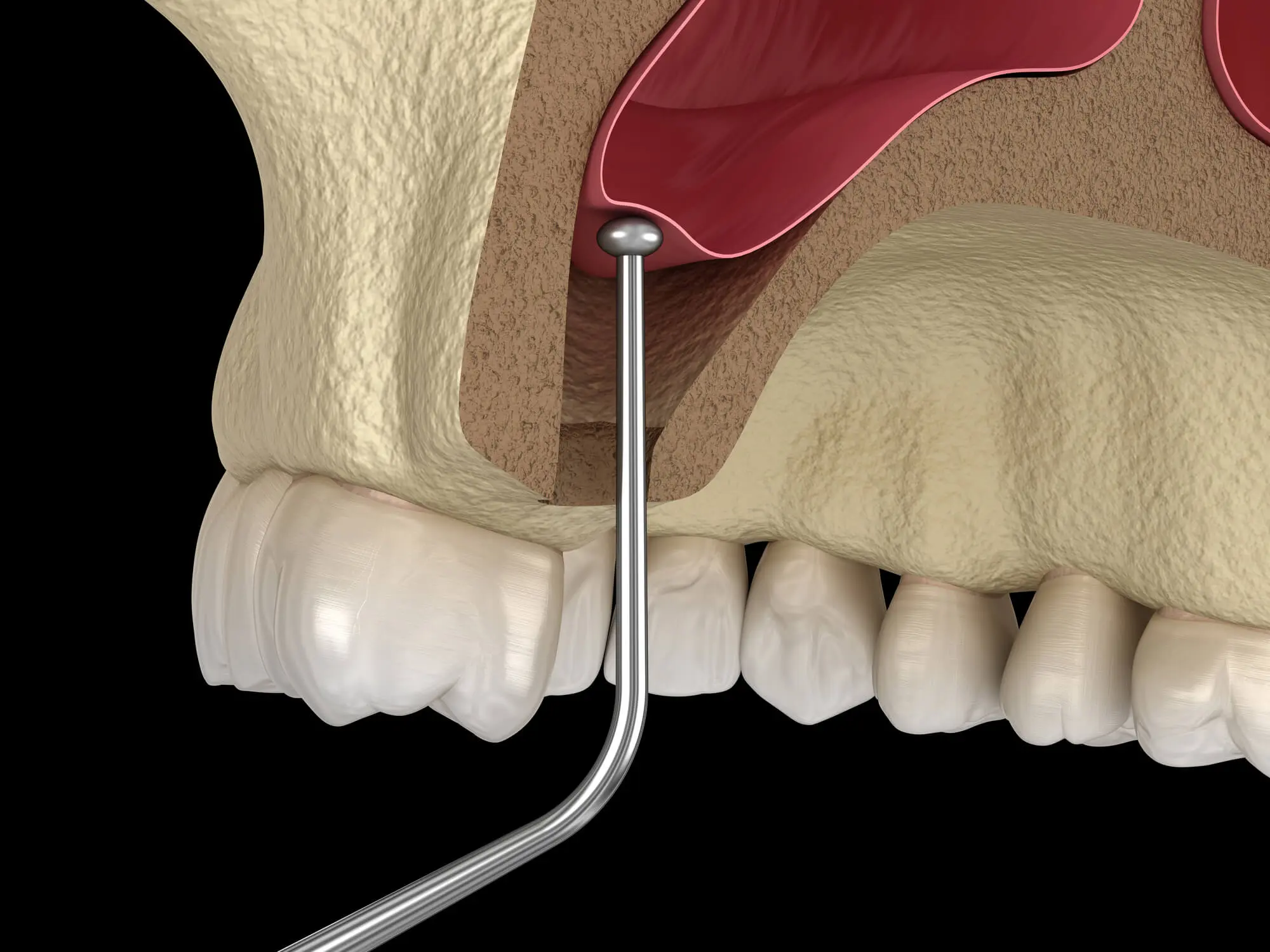 model of sinus lift