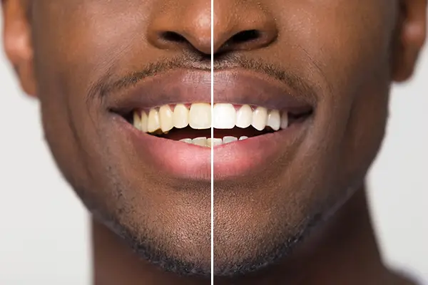 teeth whitening before and after