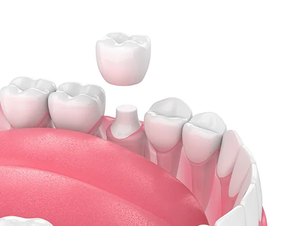 dental crown