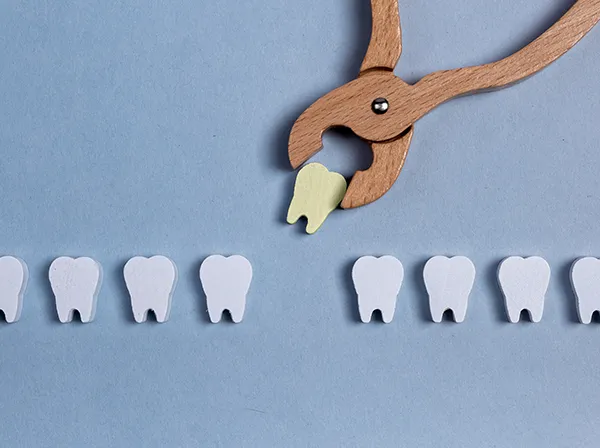 illustration of tooth extraction
