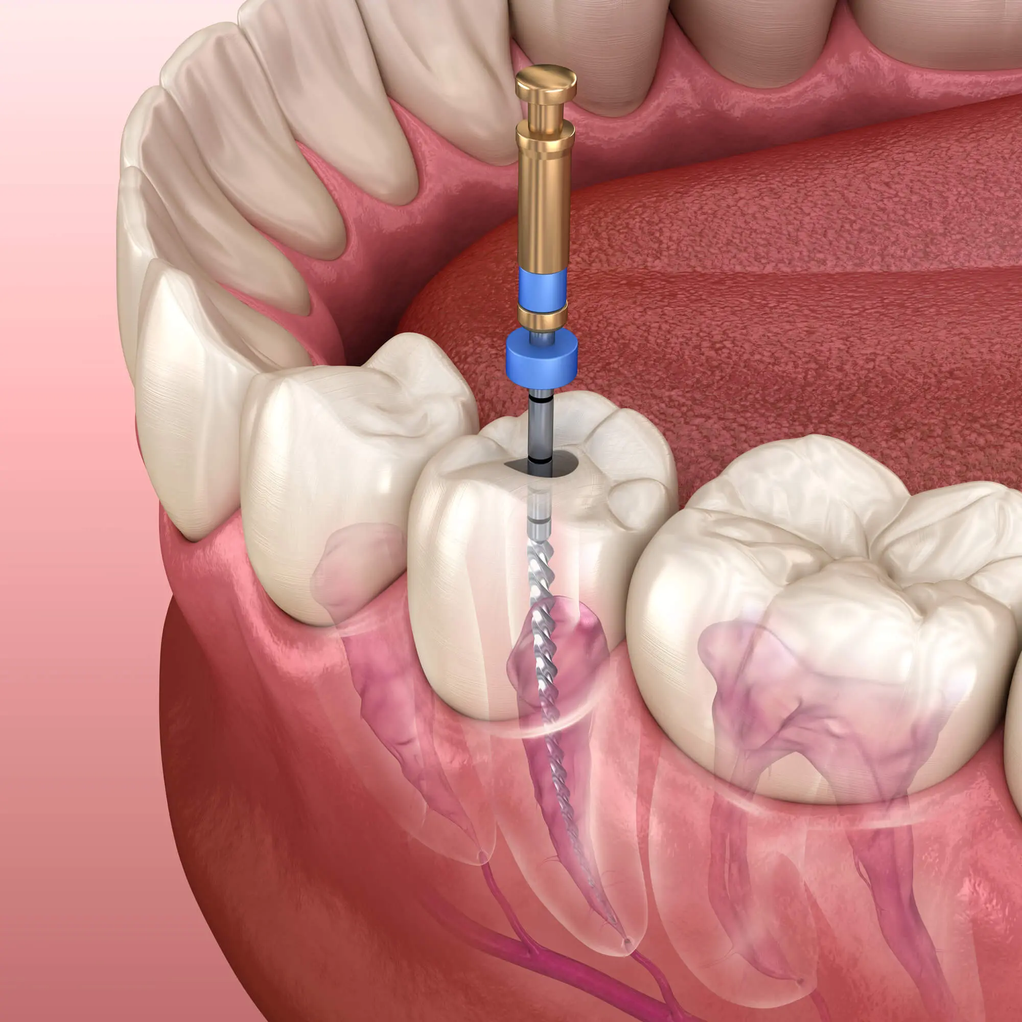 model of root canal