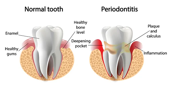 periodontal disease table