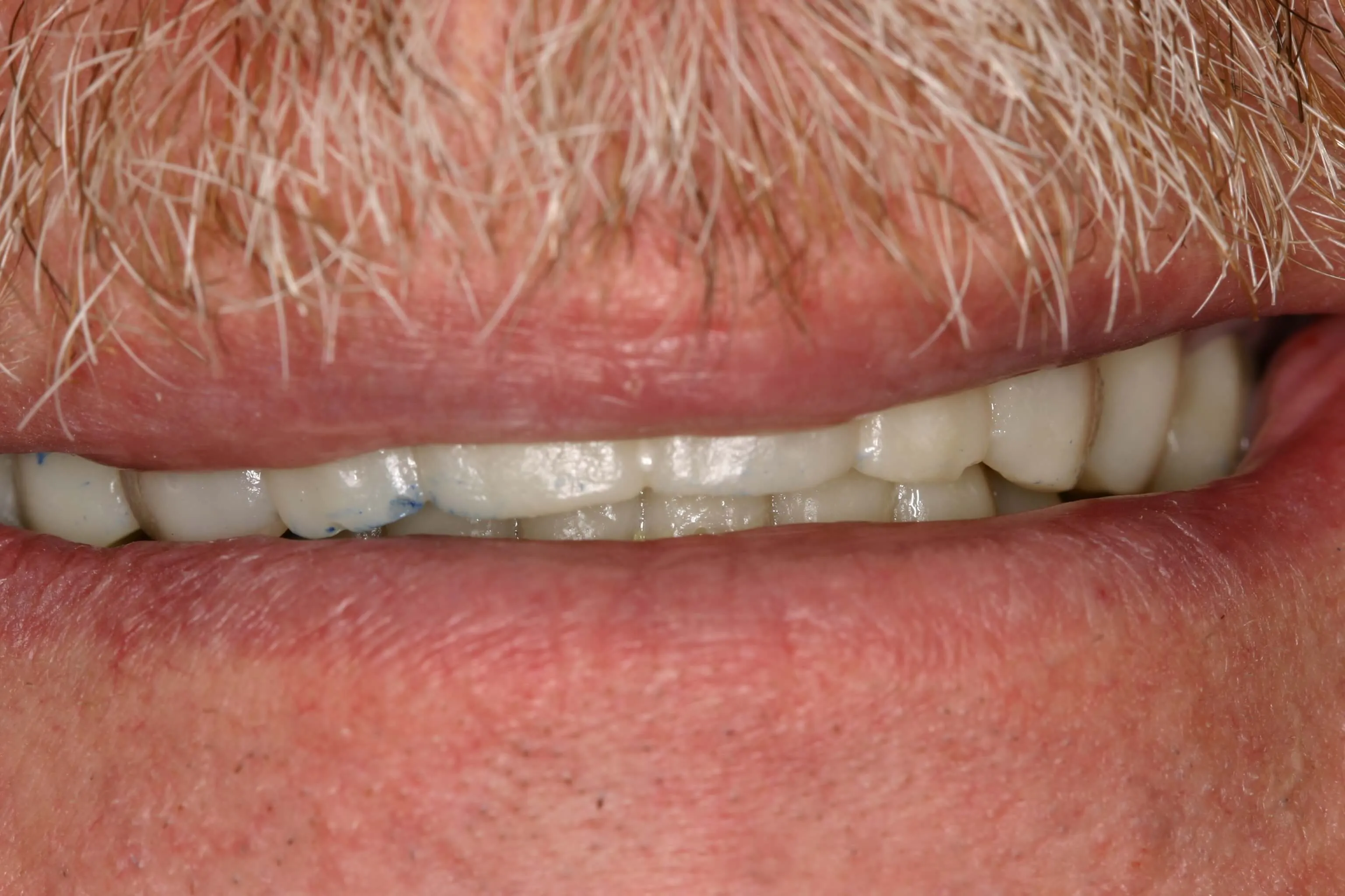 patient's mouth after treatment