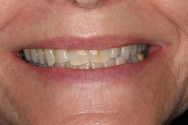 patient's mouth before treatment