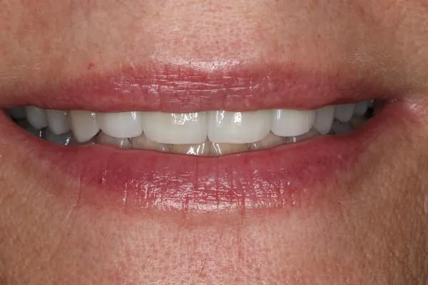 patient's mouth after treatment
