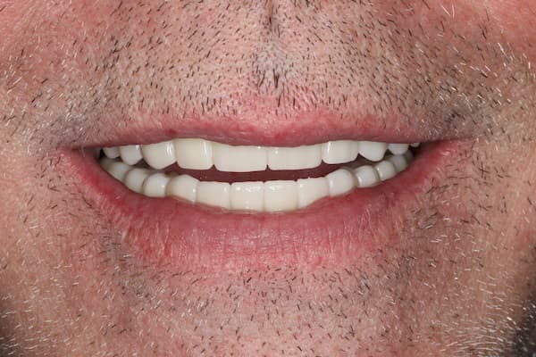 patient's mouth after treatment