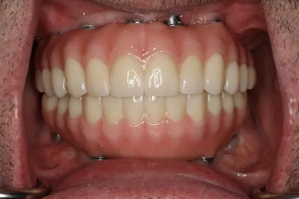 patient's mouth after treatment
