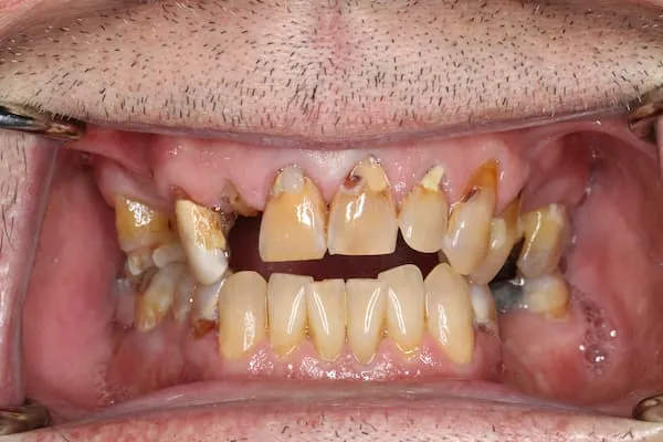 patient's mouth before treatment