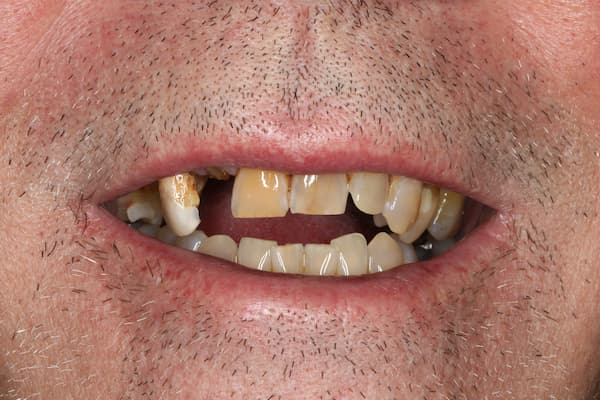 patient's mouth before treatment