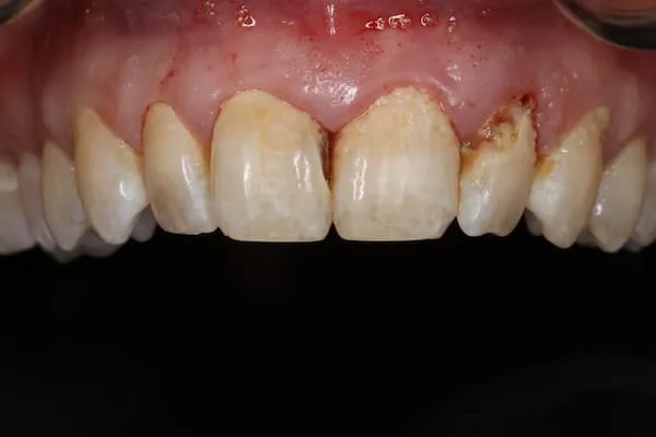 patient's mouth before treatment