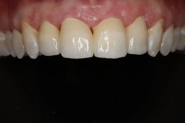 patient's mouth after treatment