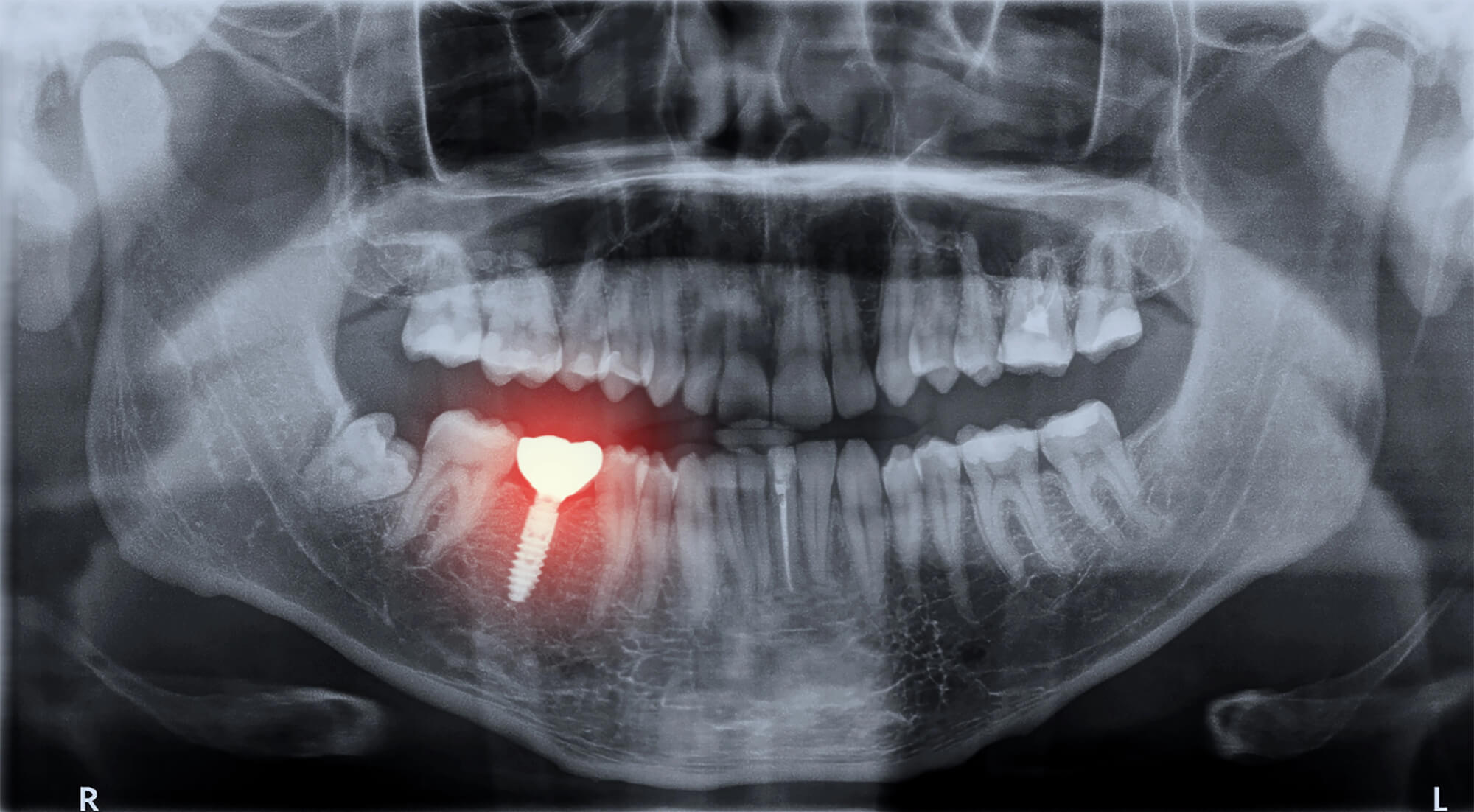 Xray image of a single dental implant norfolk va