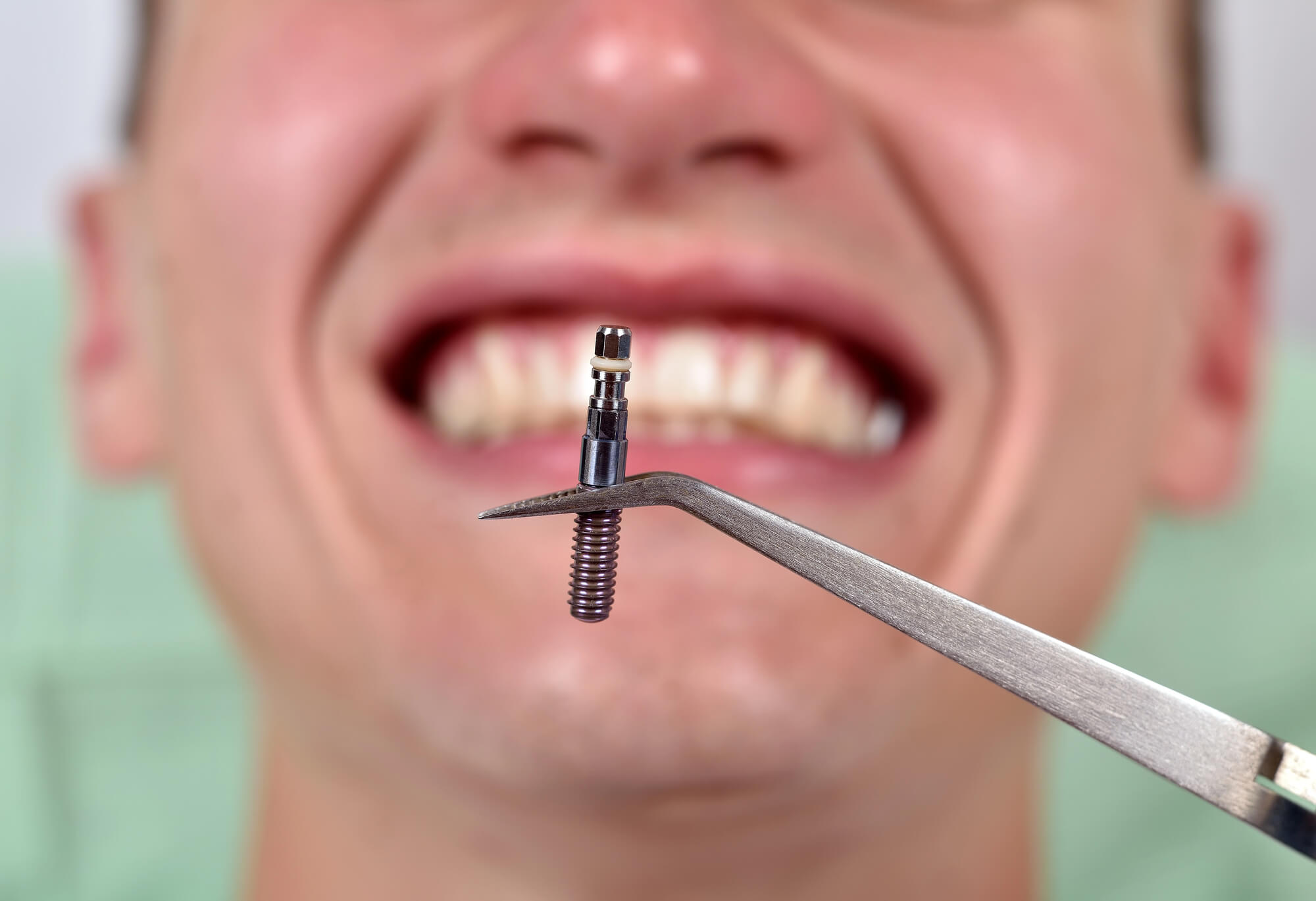 one of the implants used for implant dentures norfolk va