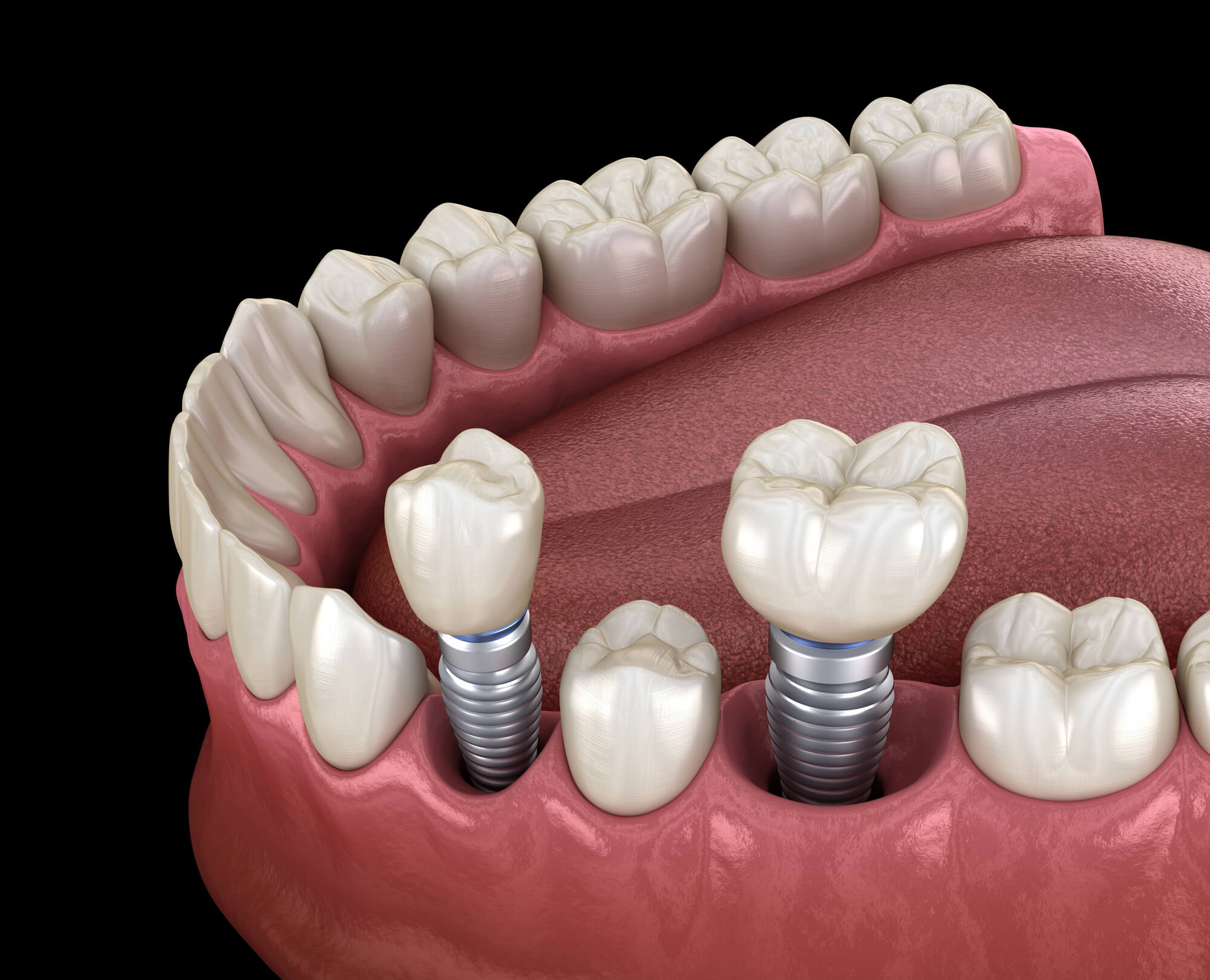 all on 4 dental implants virginia beach va image