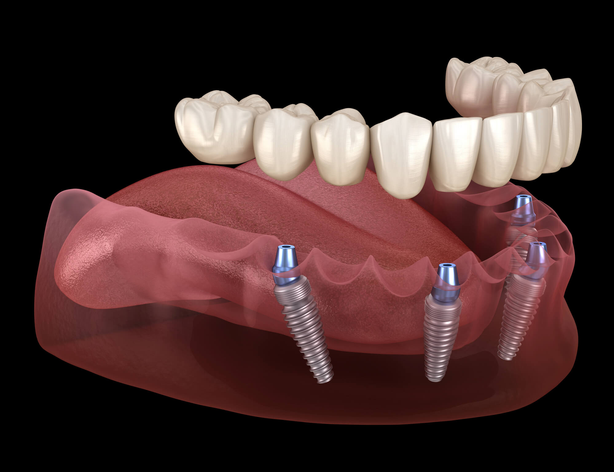 3D all on 4 dental implants virginia beach va