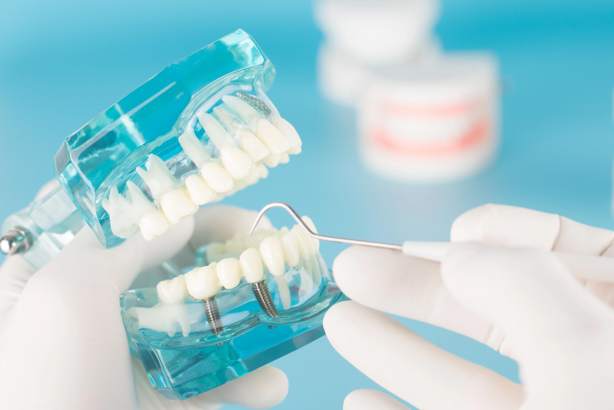 dentist explaining dental implant restorations