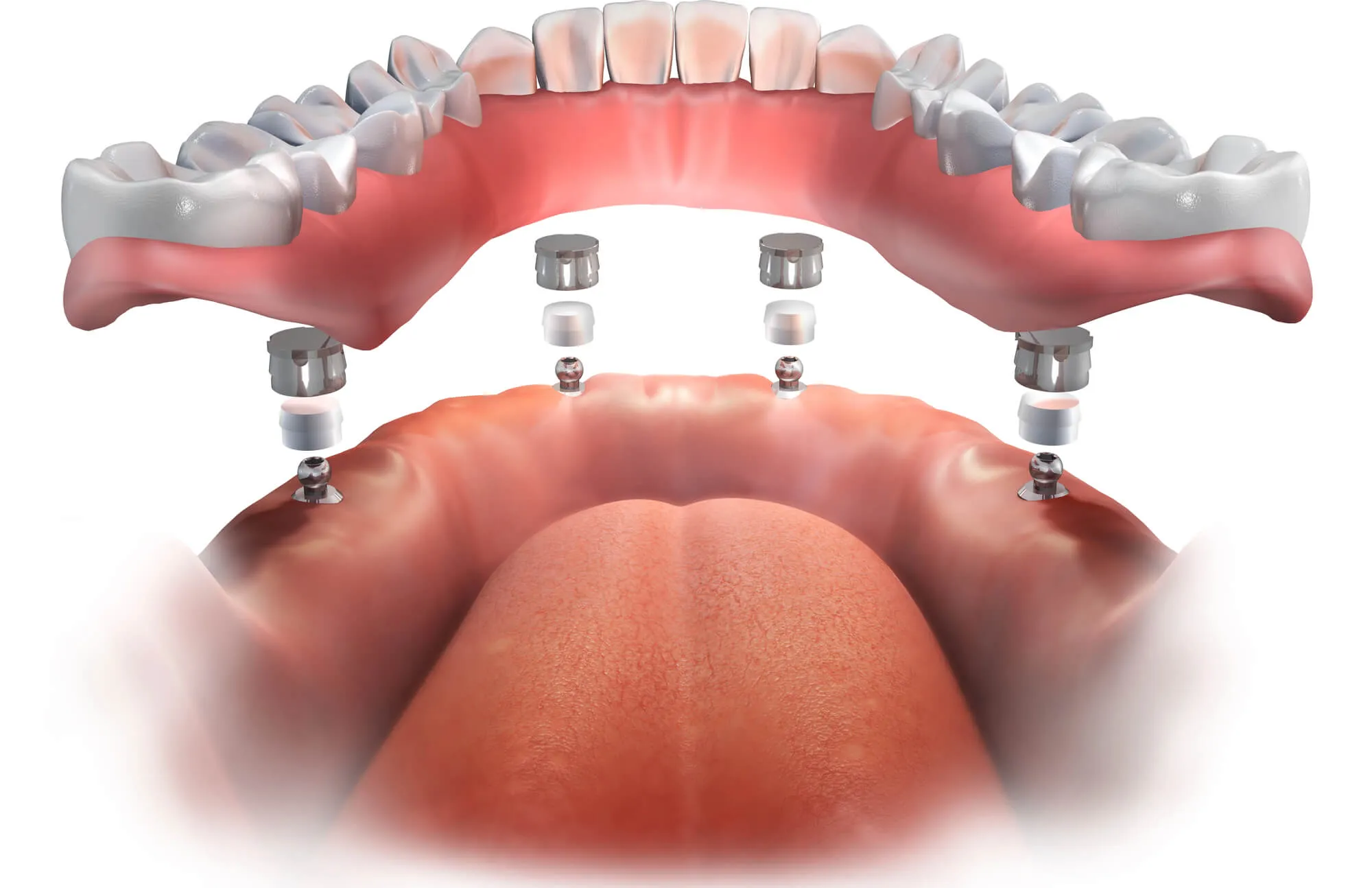 3D illustration of implant dentures norfolk va