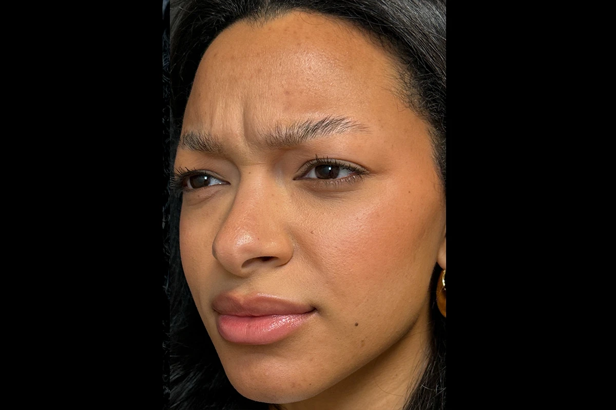 Middle-aged woman before wrinkle relaxer