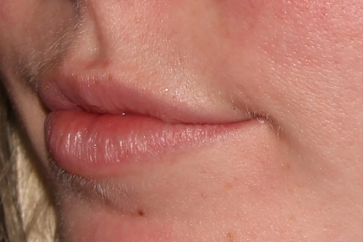 Young woman before lip filler