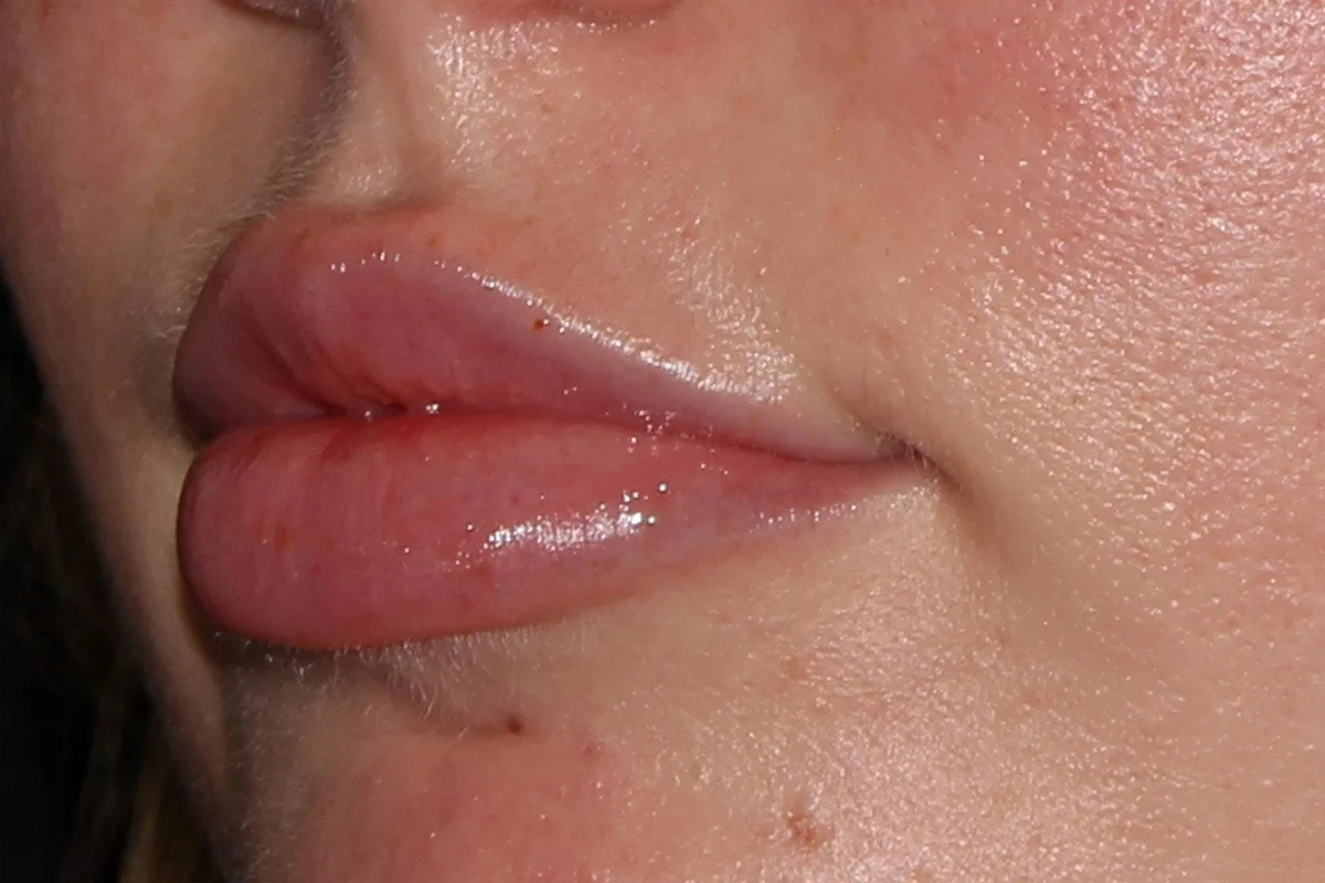 Young woman after lip filler