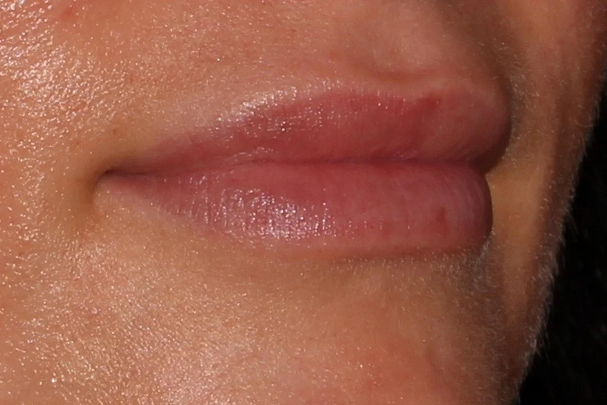 Young woman before lip filler 