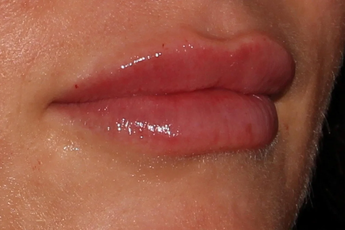 Young woman after lip filler