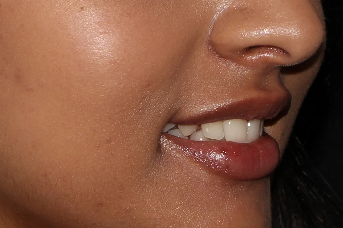 Young woman after lip filler
