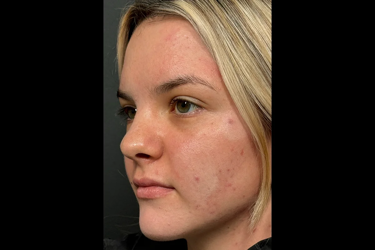 Young woman before lip filler