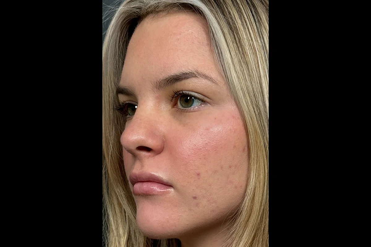 Young woman after lip filler