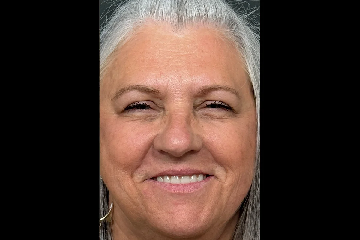 Older woman before lip filler
