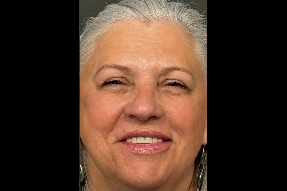 Older woman after lip filler