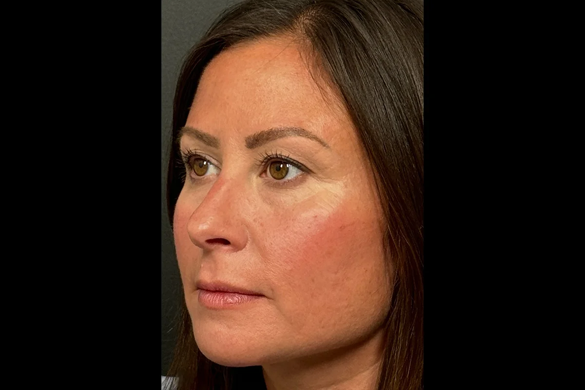 Middle-aged woman before lip filler