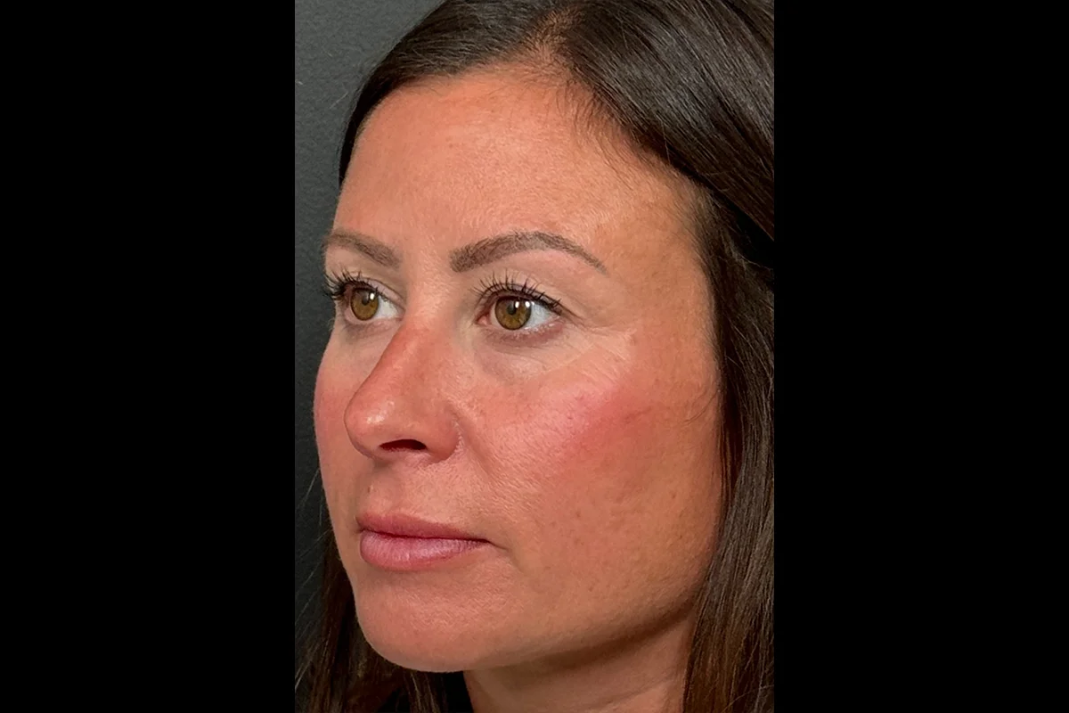 Middle-aged woman after lip filler