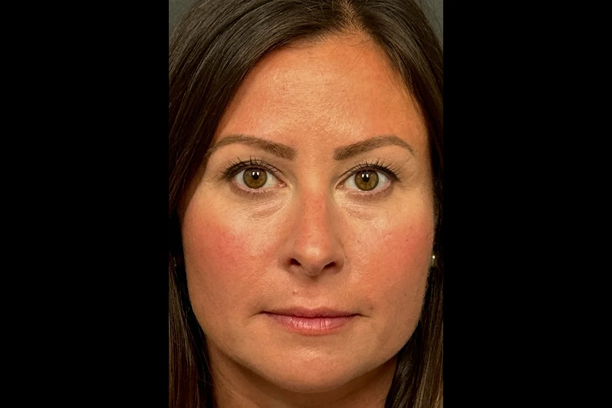 Middle-aged woman before lip filler