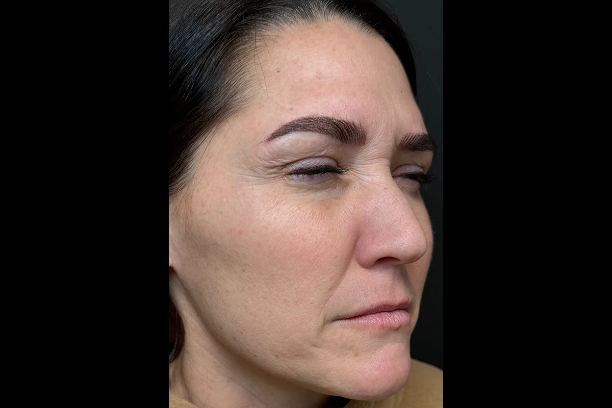 Middle-aged woman before Botox