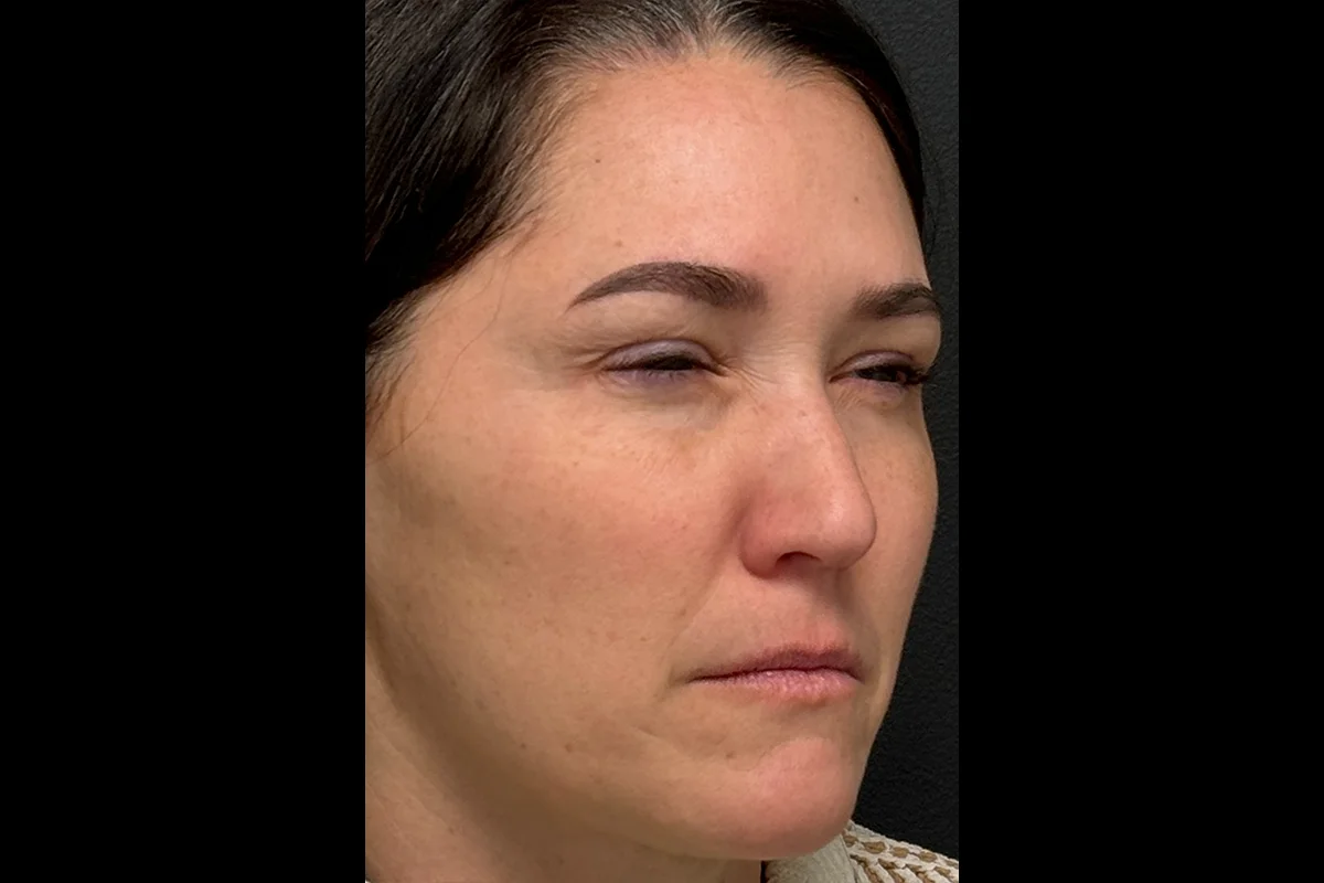 Middle-aged woman after Botox