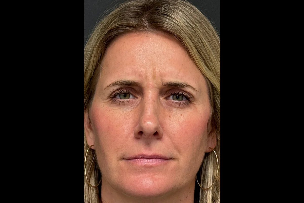 Middle-aged woman before Botox