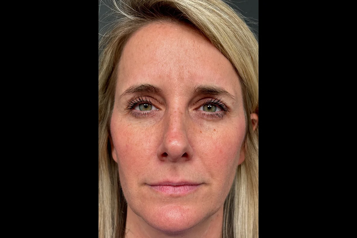 Middle-aged woman after Botox