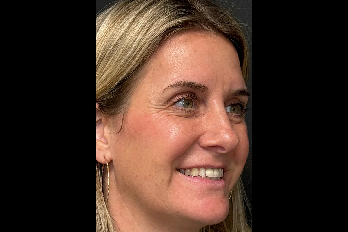 Middle-aged woman before Botox