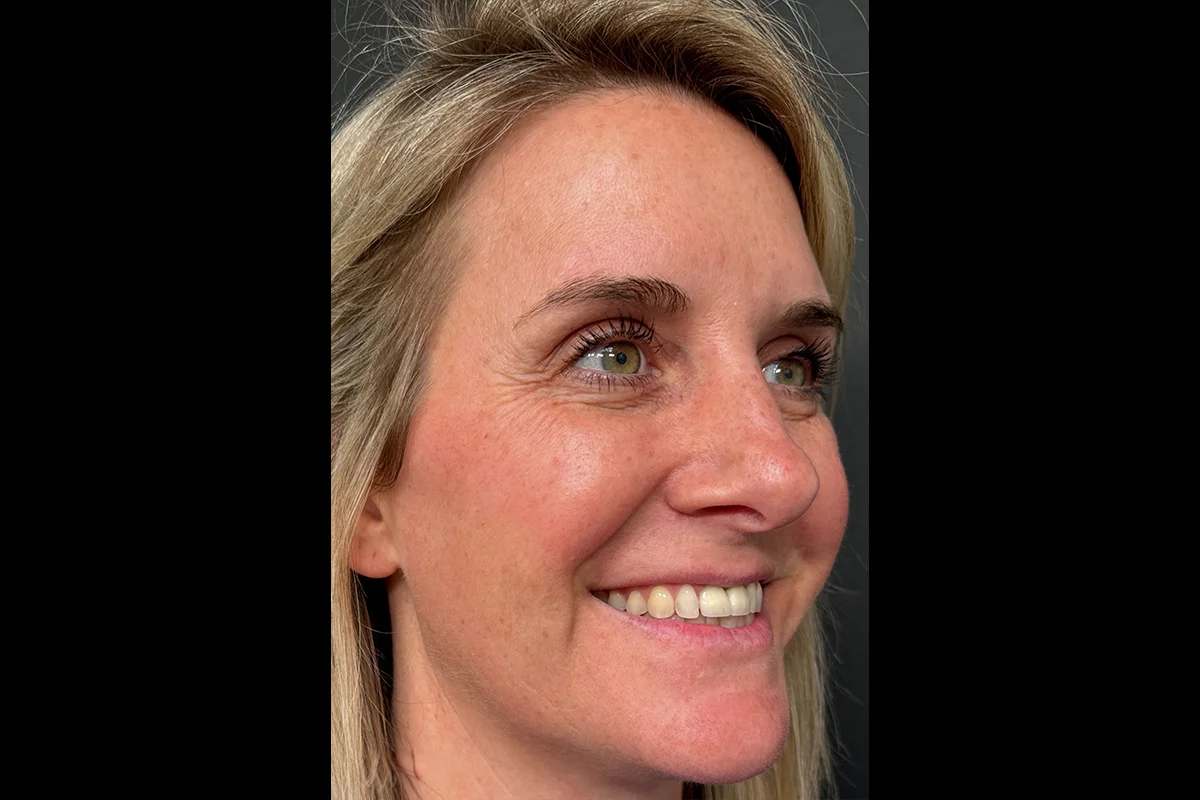Middle-aged woman after Botox
